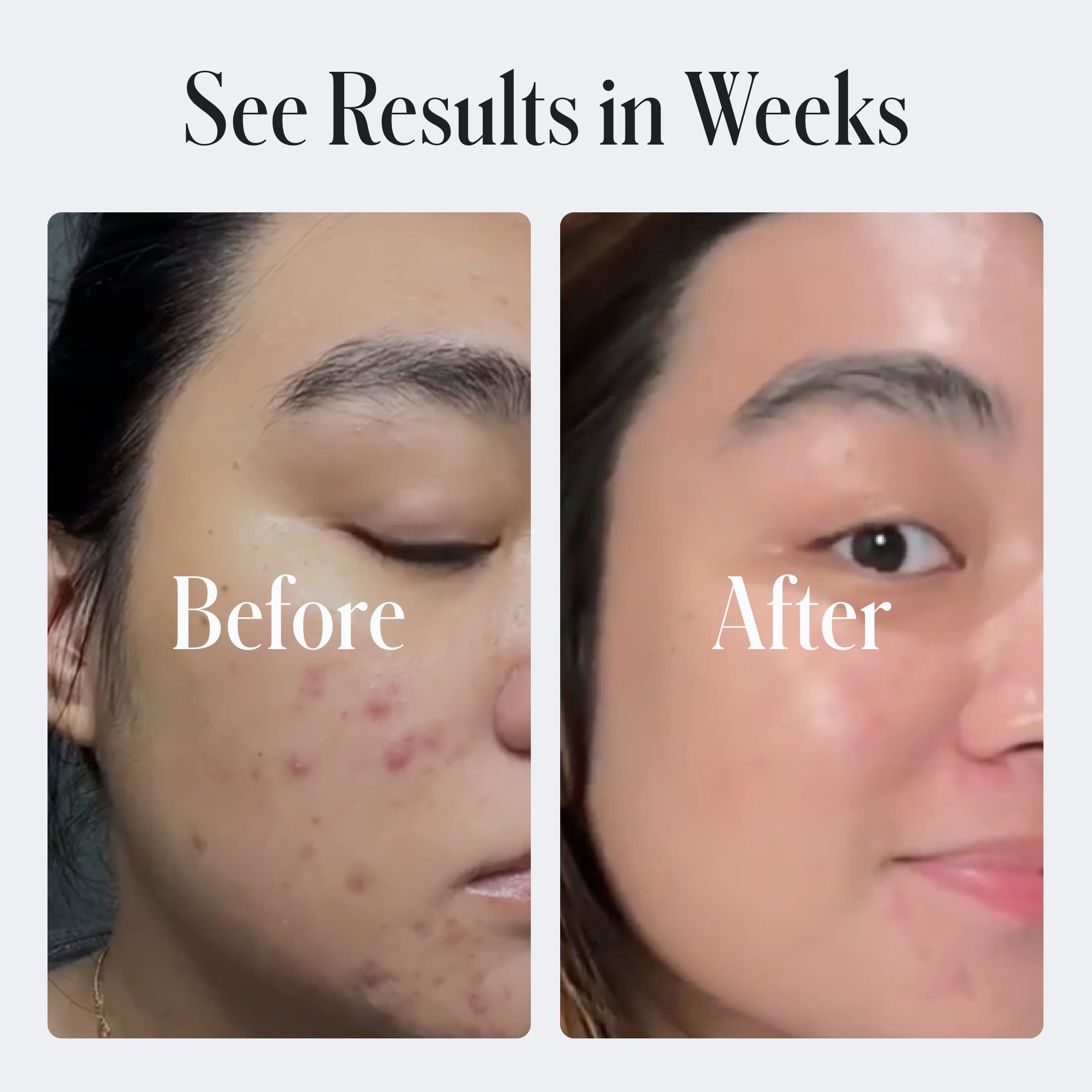 Side-by-side photos show a cheek with acne in the Before image and clearer skin after using Geologie Clear Skin Face Cream in the After image, captioned See Results in Weeks.