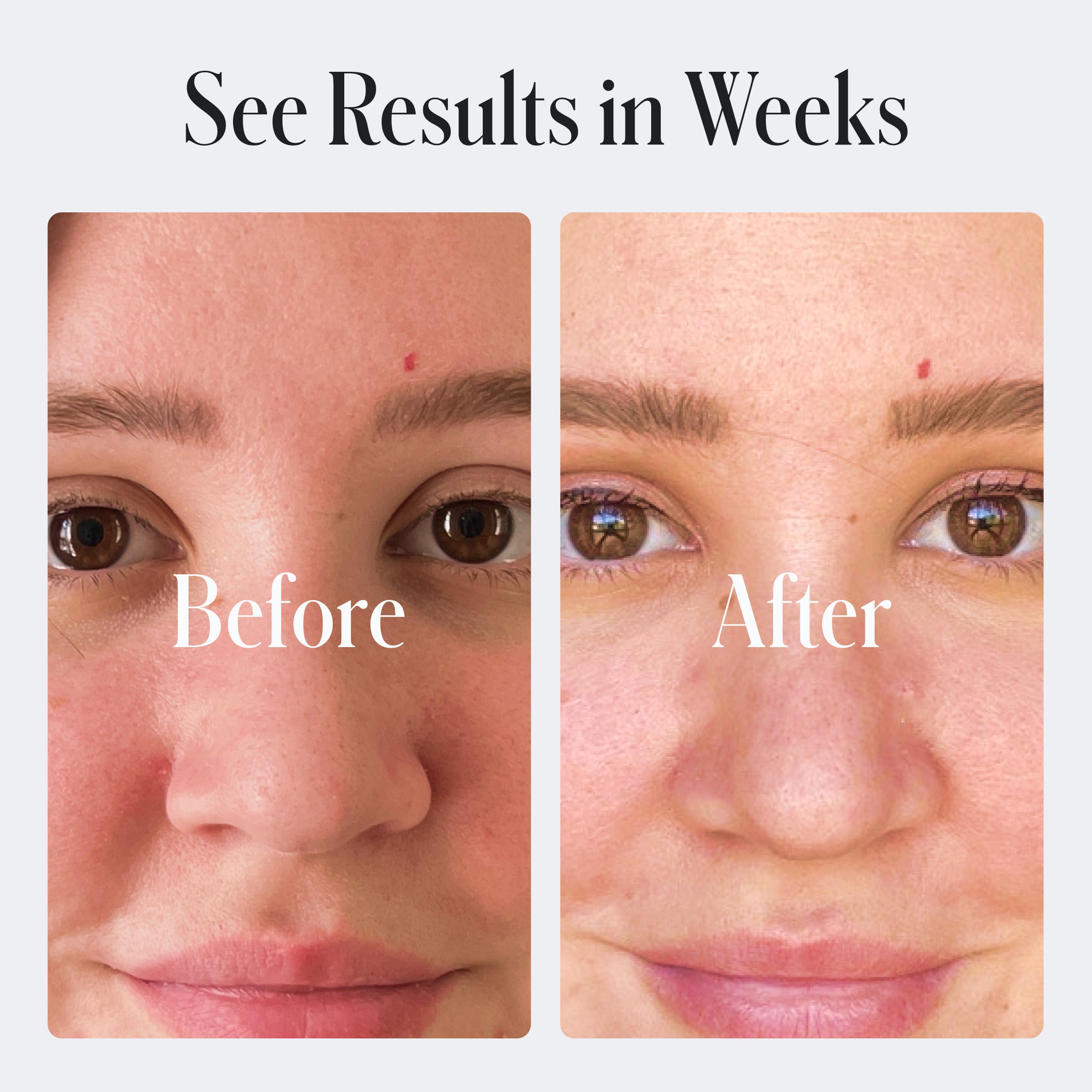 Side-by-side close-ups of a person’s face, labeled Before and After, show clearer skin in the After image. Text reads: See Results in Weeks with Acne Control Face Wash by Geologie.