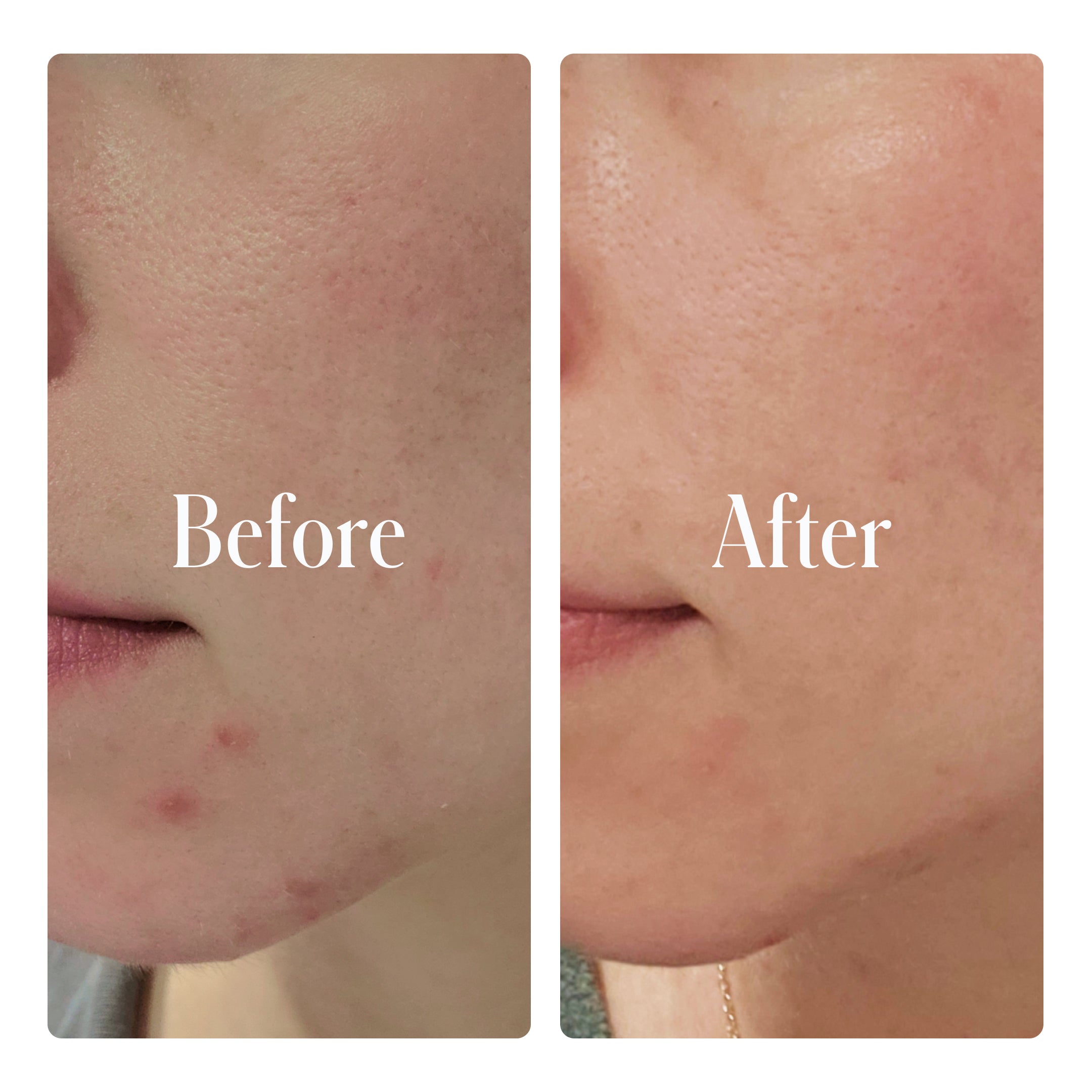 A side-by-side comparison showcases a person's cheek and chin before and after using Geologie's Clear System Set, highlighting reduced redness and blemishes in the After image.