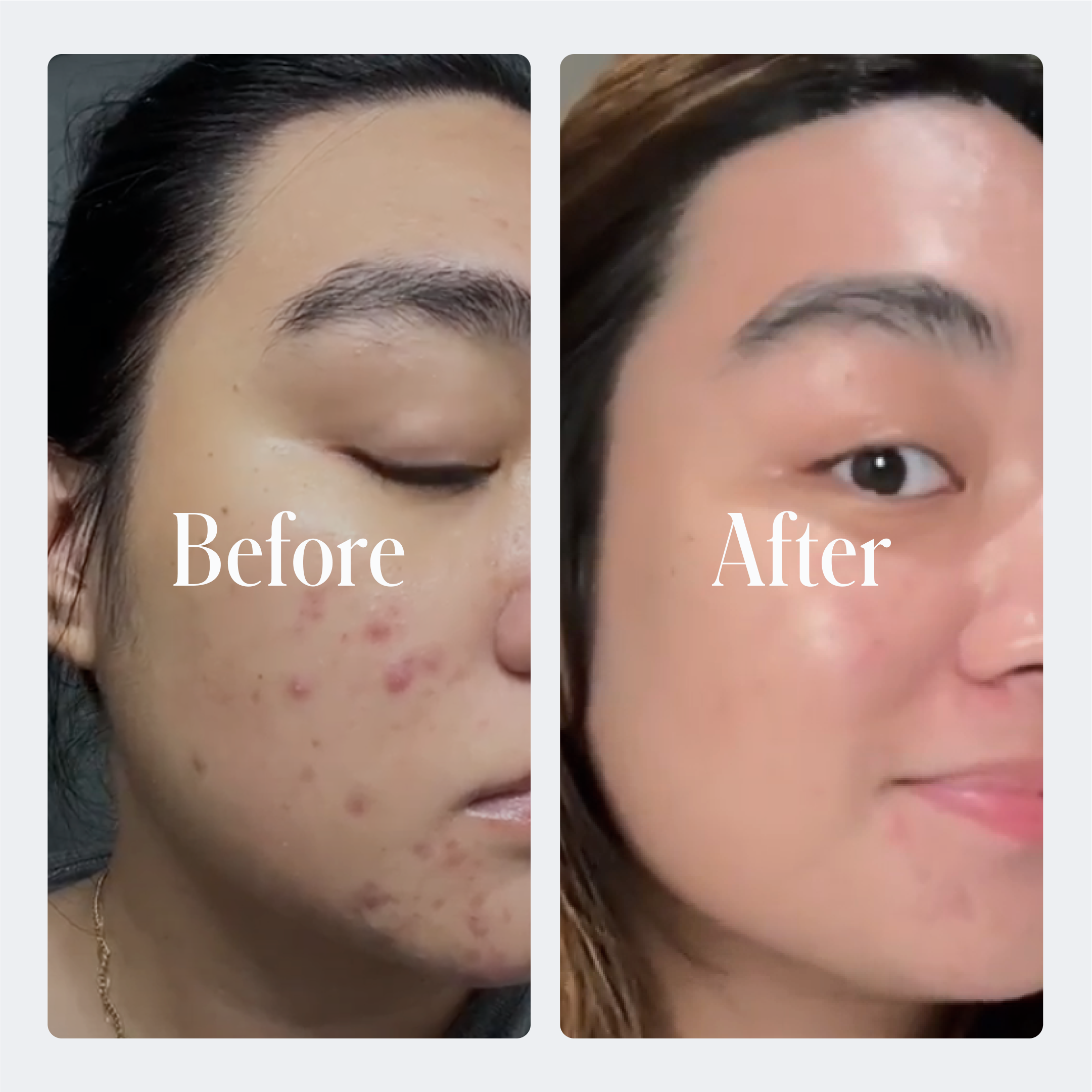 Geologie Acne Starter Kit